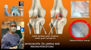 Artroskobik Ön Çapraz Bağ Rekonstrüksiyonu