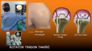 Rotator Tendon Tamiri